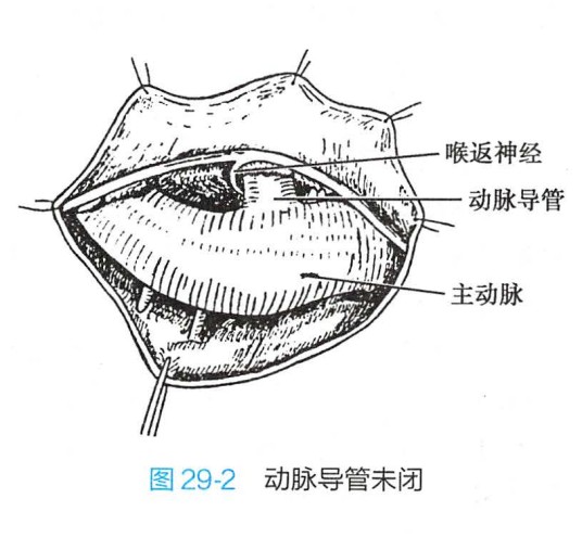 动脉导管未闭