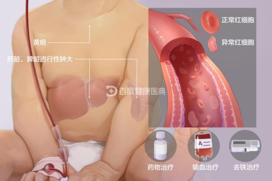 珠蛋白生成障碍性贫血
