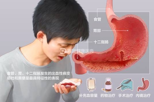上消化道出血