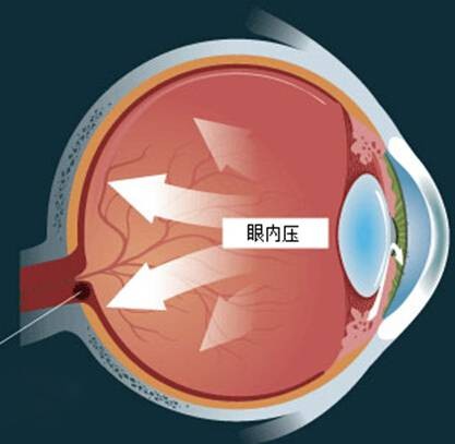 眼压