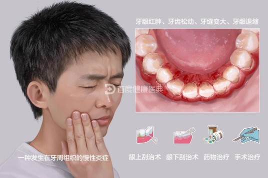 牙周炎(病名)