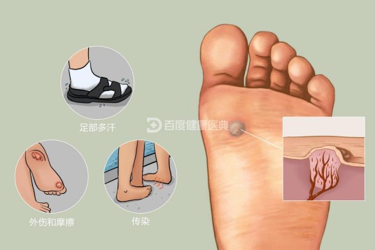 跖疣