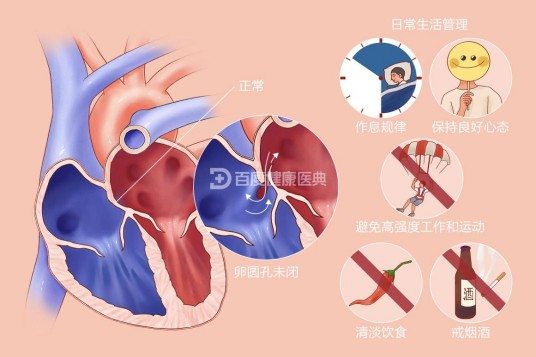 卵圆孔未闭