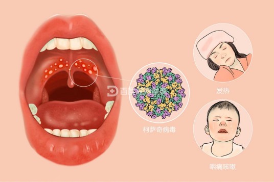 疱疹性咽峡炎