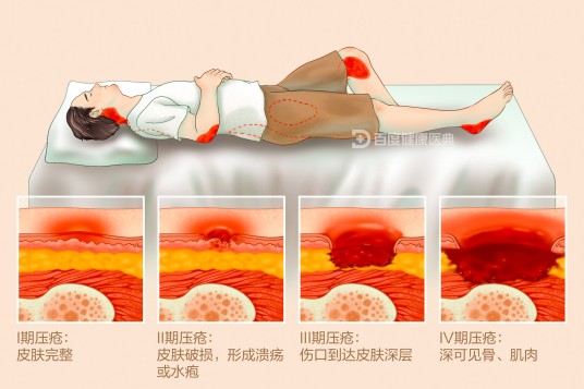 压疮