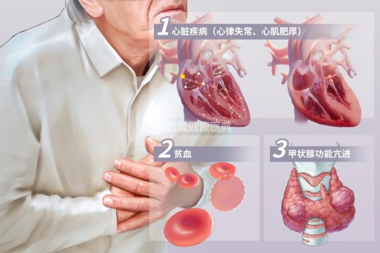 心悸(中医病证名)