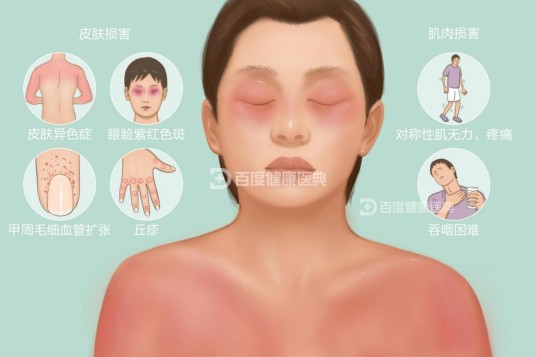 皮肌炎