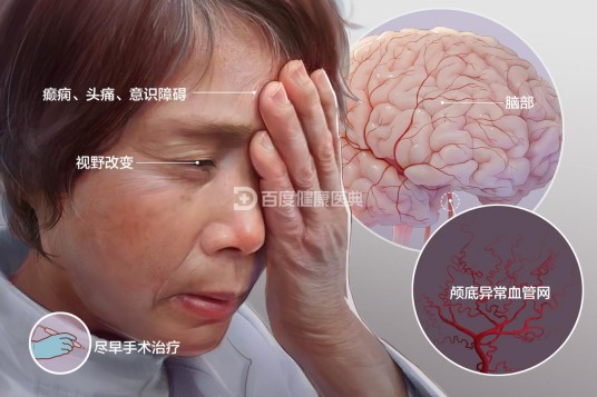 烟雾病