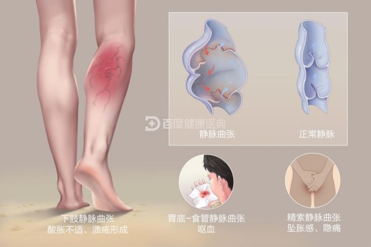 静脉曲张