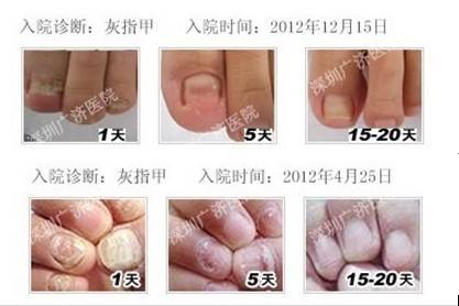 真菌疗法