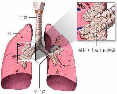 肺鳞癌