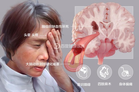 脑梗死