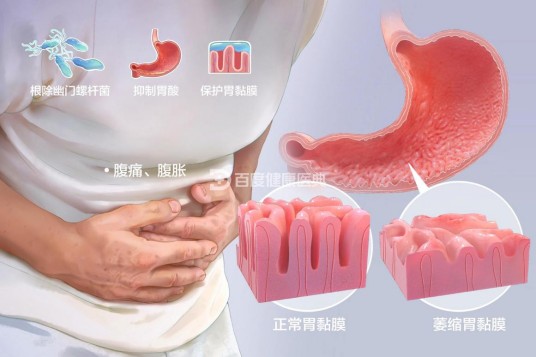 萎缩性胃炎