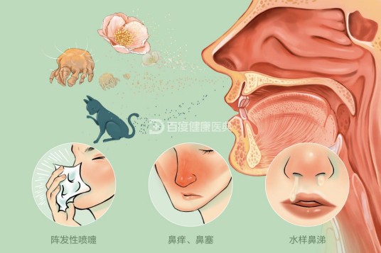 过敏性鼻炎（疾病名）