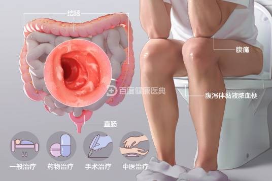 溃疡性结肠炎