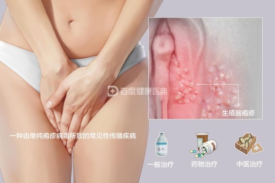 生殖器疱疹