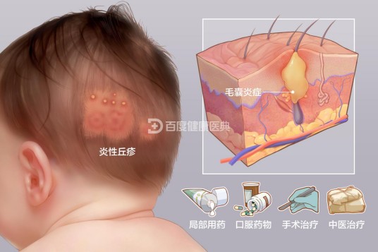 头皮毛囊炎