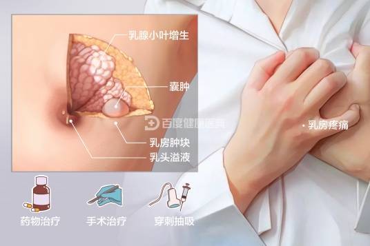乳腺增生症