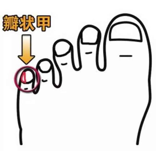 跰趾