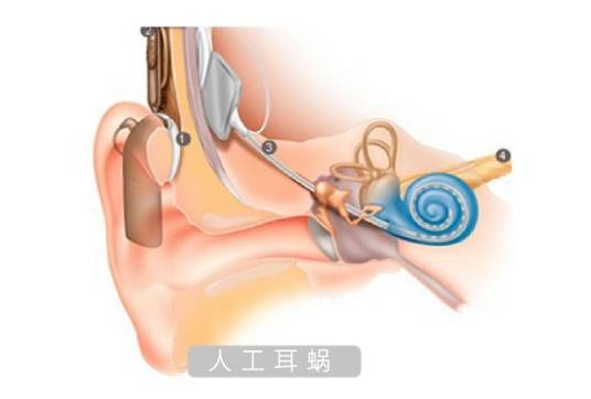 人工耳蜗