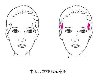 颞部填充