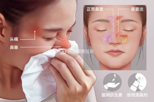 鼻窦炎(一个或多个鼻窦发生的炎症)