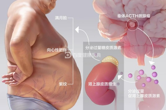 库欣综合征