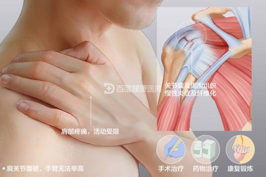 肩周炎