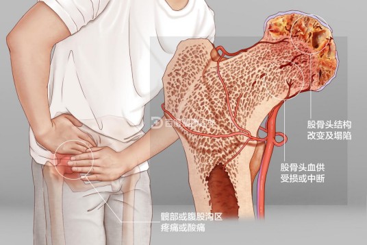 股骨头坏死(常见的骨关节疾病)
