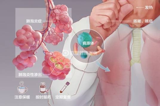 肺炎（疾病）