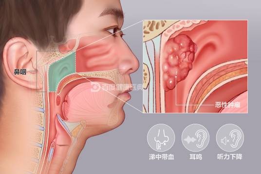 鼻咽癌（发生于鼻咽腔顶部和侧壁的恶性肿瘤）