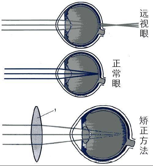 远视（眼科疾病）
