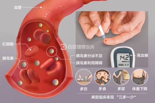 糖尿病并发症