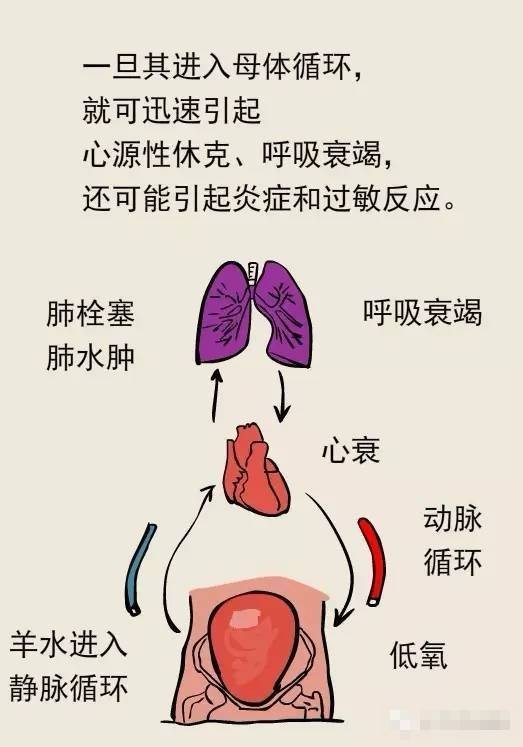 羊水栓塞症