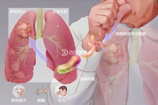 肺结核(疾病)