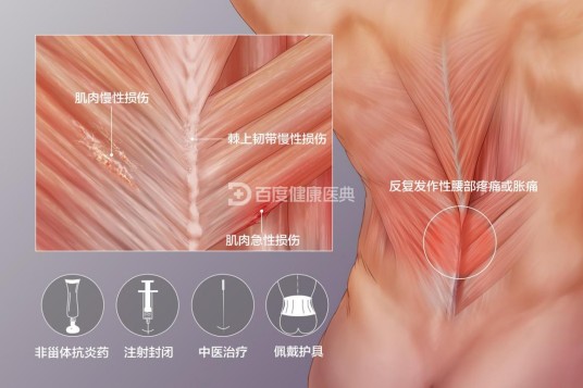 腰肌劳损