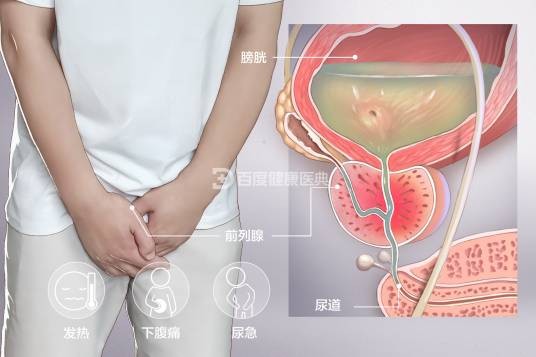 前列腺炎(病症)