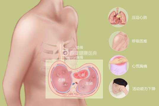 漏斗胸