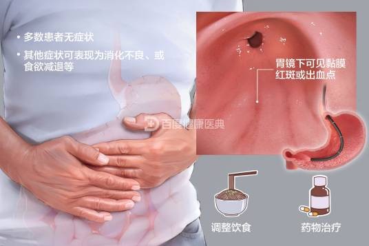 慢性浅表性胃炎