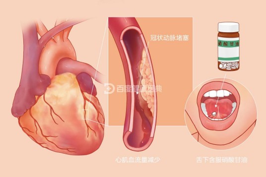 心绞痛