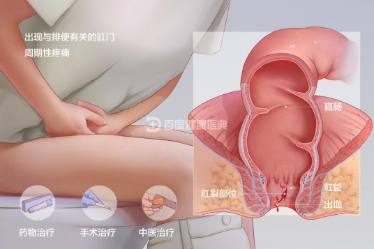肛裂