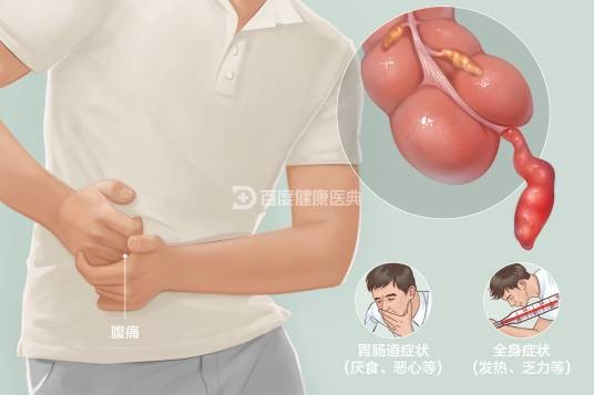 急性阑尾炎