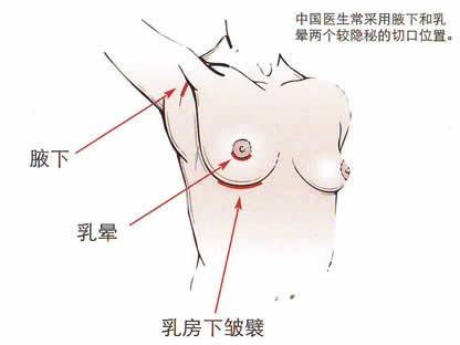 乳头整形