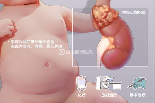 神经母细胞瘤