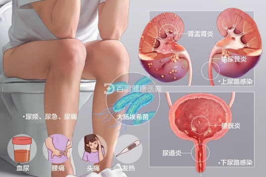 尿路感染