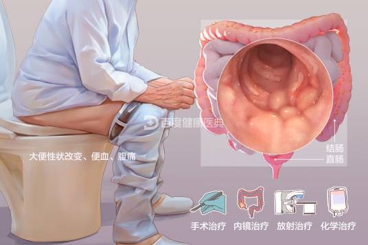 大肠癌