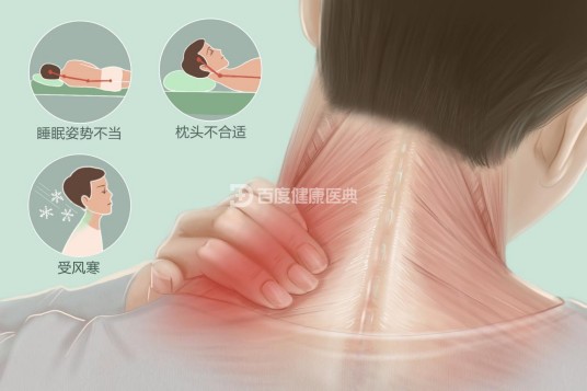 落枕