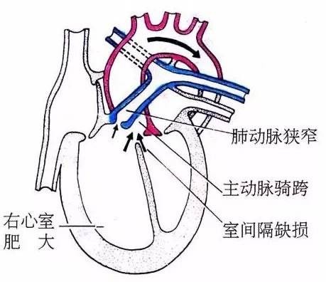 法洛四联症