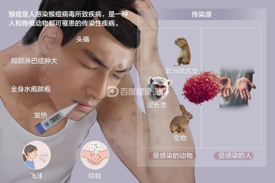 猴痘