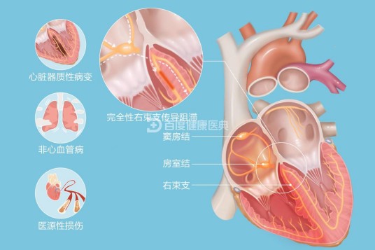 完全性右束支传导阻滞